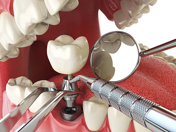 Best Emergency Root Canal Treatment in Mvell, AR